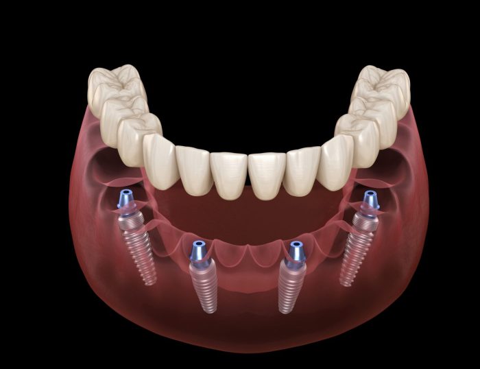 A permanently cemented-in-place crown or bridge is categorized as a