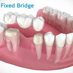 A permanently cemented-in-place crown or bridge is categorized as a