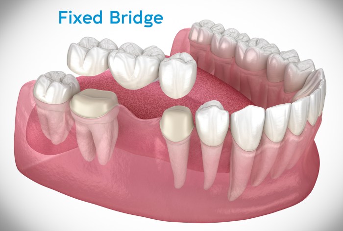 A permanently cemented-in-place crown or bridge is categorized as a